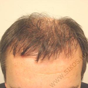 hajátültetés, hajbeültetés után