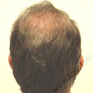 hajátültetés, hajbeültetés után