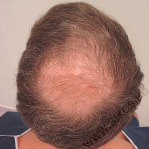 hajátültetés, hajbeültetés előtt