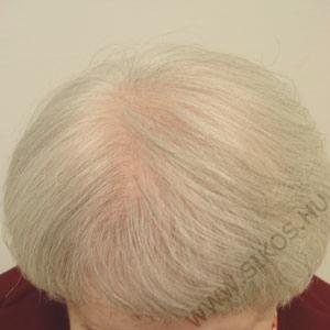 hajátültetés, hajbeültetés női diffúz hajhiány esetén. Műtét után