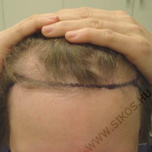 hajbeültetés, hajátültetés női paciens hajvonal pótlása előtt