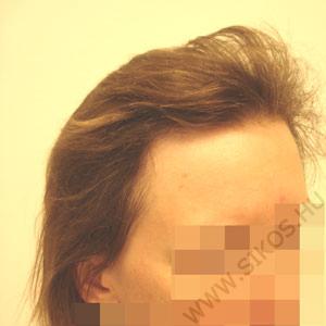hajbeültetés, hajátültetés női paciens hajvonal pótlása után